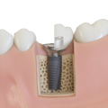 featured image thumbnail for post Place the Healing Abutment or temporary restoration - SINGLE