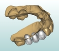 featured image thumbnail for post Design an ideal prosthetic bridge - PARTIAL