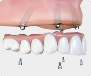 Full Arch Replacement